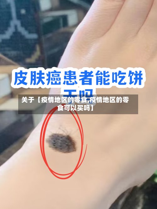 关于【疫情地区的零食,疫情地区的零食可以买吗】