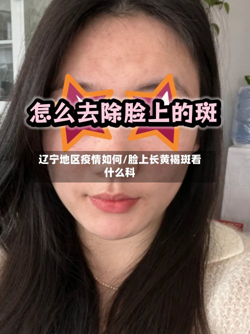 辽宁地区疫情如何/脸上长黄褐斑看什么科