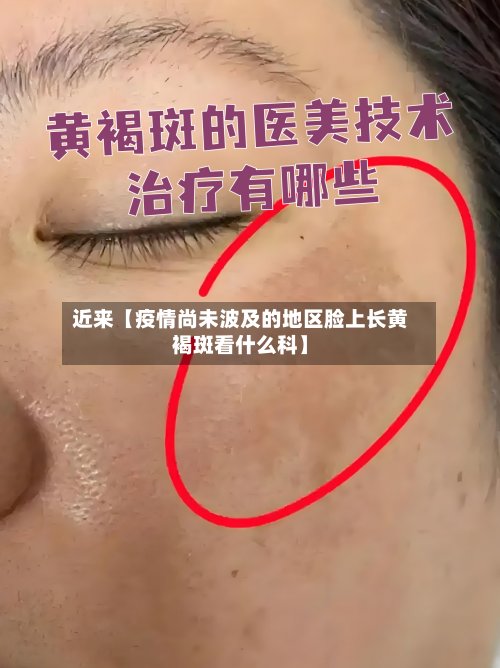 近来【疫情尚未波及的地区脸上长黄褐斑看什么科】