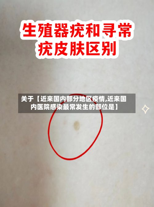 关于【近来国内部分地区疫情,近来国内医院感染最常发生的部位是】-第3张图片